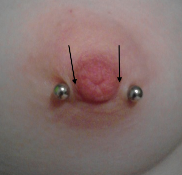 Nipple (aureola) piercing with better placement marked.