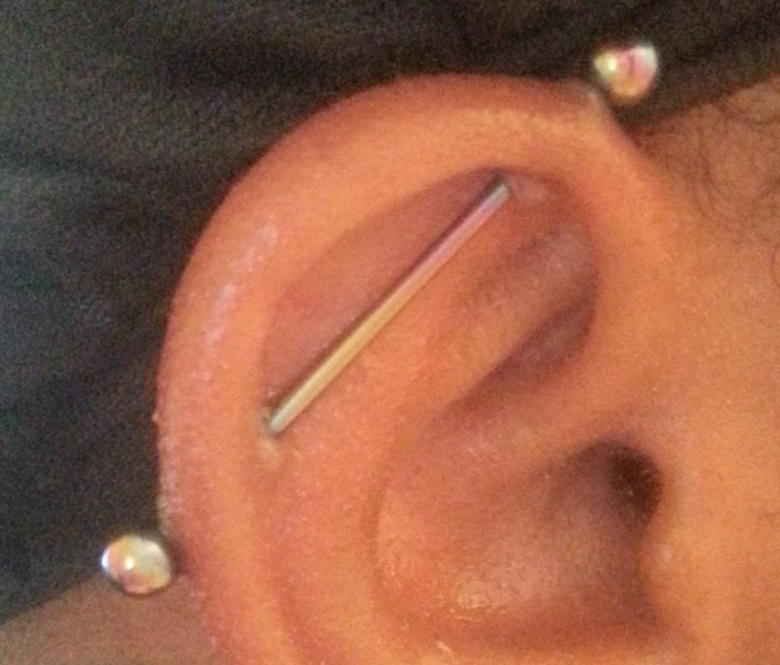 Industrial Ear Piercing with Scar Tissue Formation