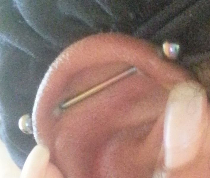 Industrial Ear Piercing with Scar Tissue Formation