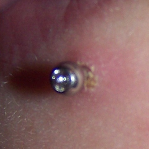 Facial view of a lower lip piercing that has been irritated by over cleaning.