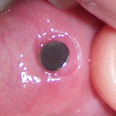 Inside mouth view of a lower lip piercing that has been irritated by over cleaning.