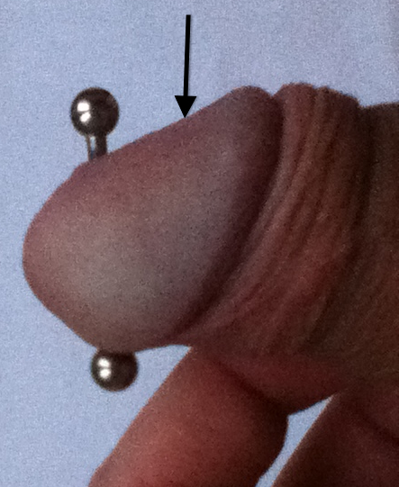 Penis with apadravya piercing and mark for traditional placement