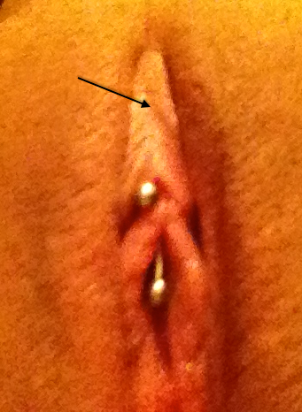 Accidental Clitoris Piercing (VCH requested)