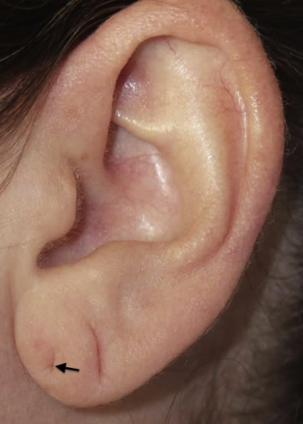 Adult Earlobe pierced in infancy, and again in adulthood