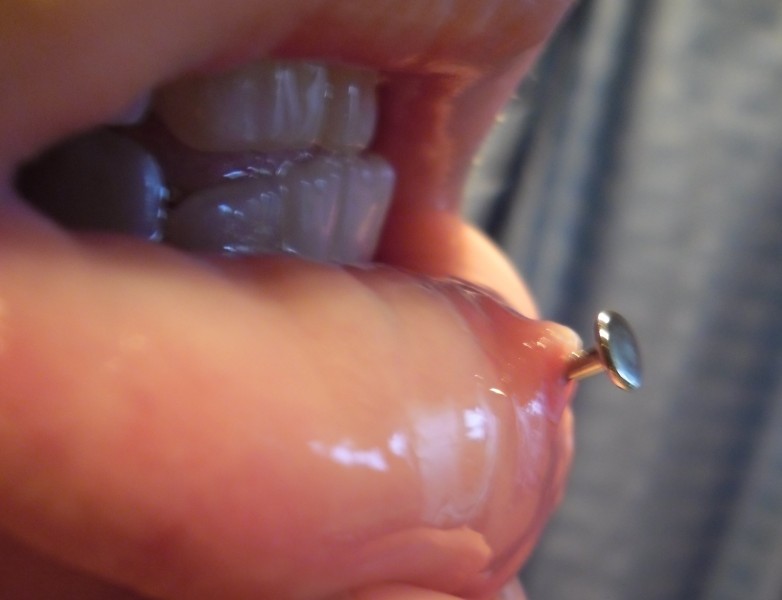 lip piercing infection inside mouth