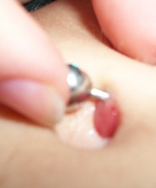 Navel piercing with Hypergranulation