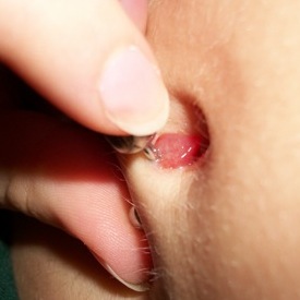 Navel piercing with Hypergranulation