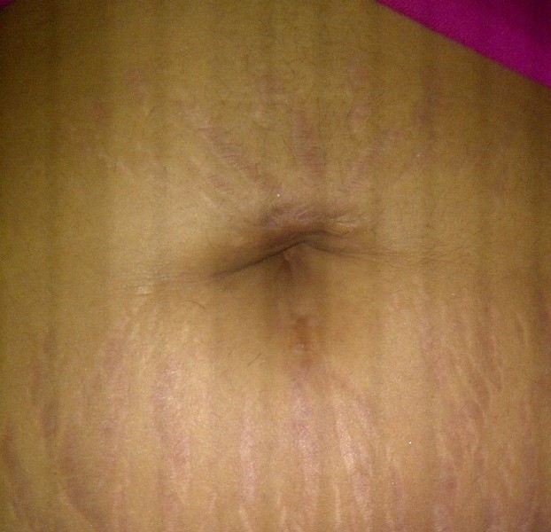 belly button piercing scar tissue