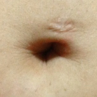 Scarred Navel - standing view