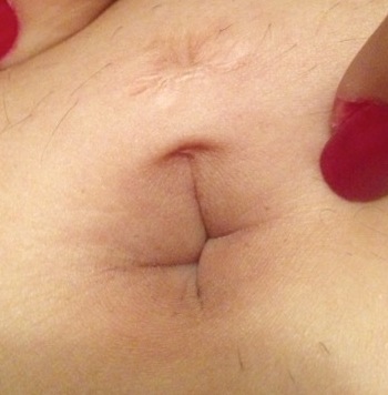 Scarred Navel - stretched view