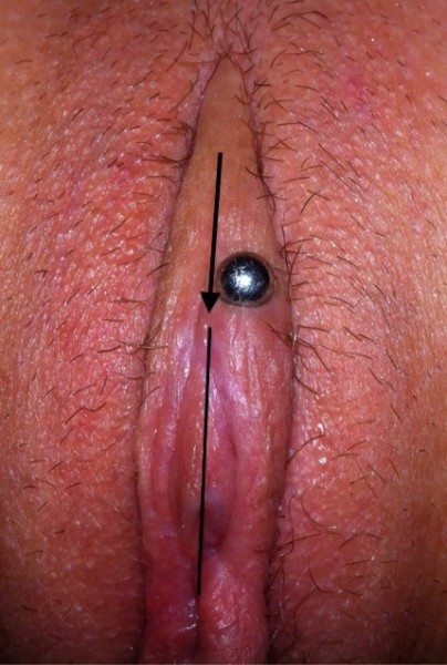 Marked image of off-center VCH piercing