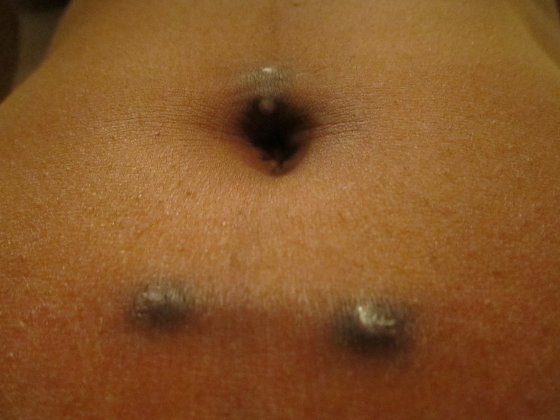 Belly Button Piercing Scar Experience Review Tutorial