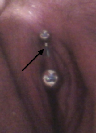 Discolored Jewelry in Migrating VCH Piercing