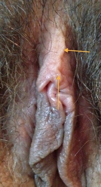 Arrow shows non-midline fold.