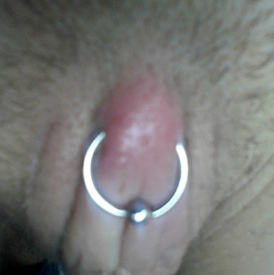 Infected--red and swollen--Horizontal Clitoral Hood (HCH) piercing in need of medical attention