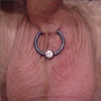 A lorum piercing with captive niobium ring placed to ignore an off-center midline ridge