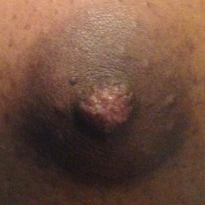 The same nipple with tip everted