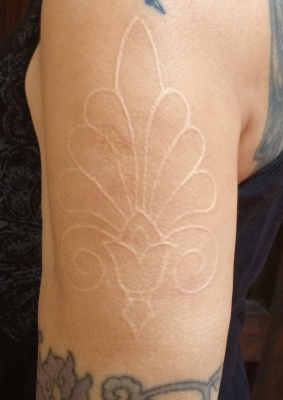 My palmette etching (scar) on left upper arm in 2017