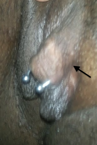 A "triangle" piercing too far forward, which accidentally punctured the clitoral glans